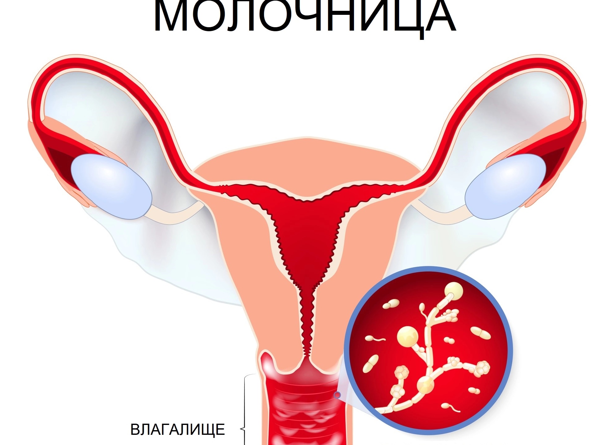 Как навсегда вылечить молочницу у женщин в домашних условиях Как навсегда вылечить молочницу у женщин в домашних условиях