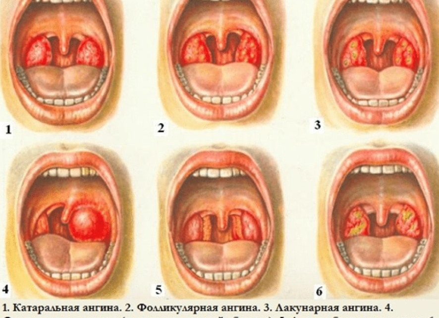 Как лечить ангину у детей в домашних условиях