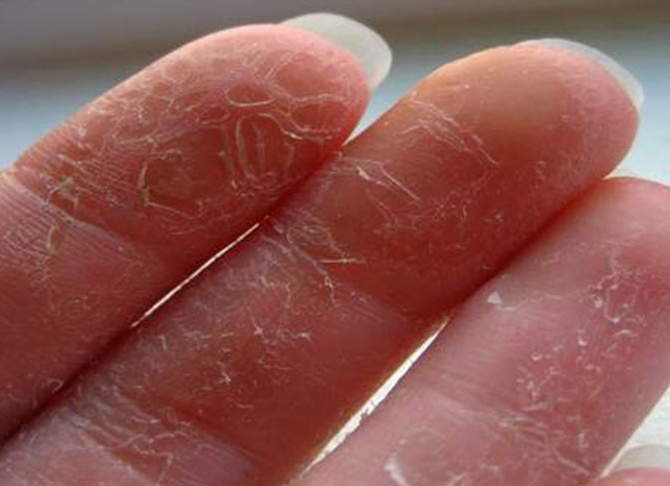 Почему облазит кожа на пальцах рук: причины Почему облазит кожа на пальцах рук: причины