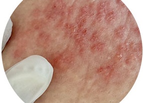 Кому и когда нужно сделать прививку от оспы