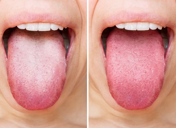 Почему появляется белый налет на языке Почему появляется белый налет на языке