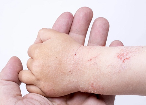 Как избавиться от цыпок на руках в домашних условиях