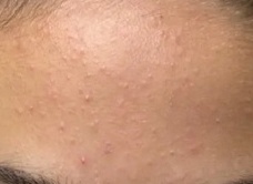 Прыщи на лбу у женщин: причины и способы лечения