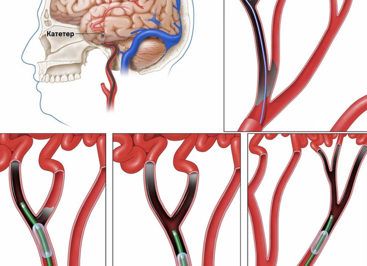 Способы чистки сосудов головного мозга в домашних условиях Способы чистки сосудов головного мозга в домашних условиях