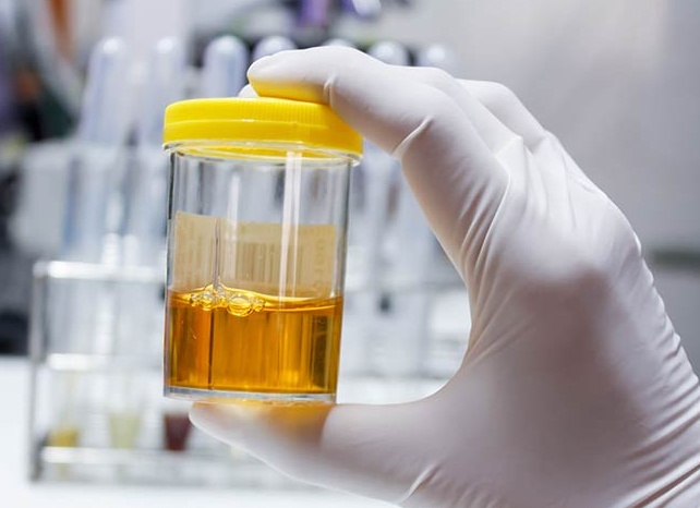 Что означает наличие слизи в моче: разбор анализа с пояснениями