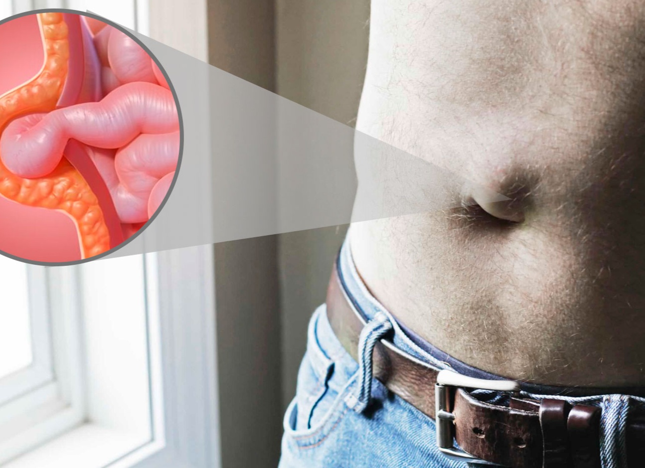 Пупочная грыжа у взрослых: причины появления, симптомы и лечение