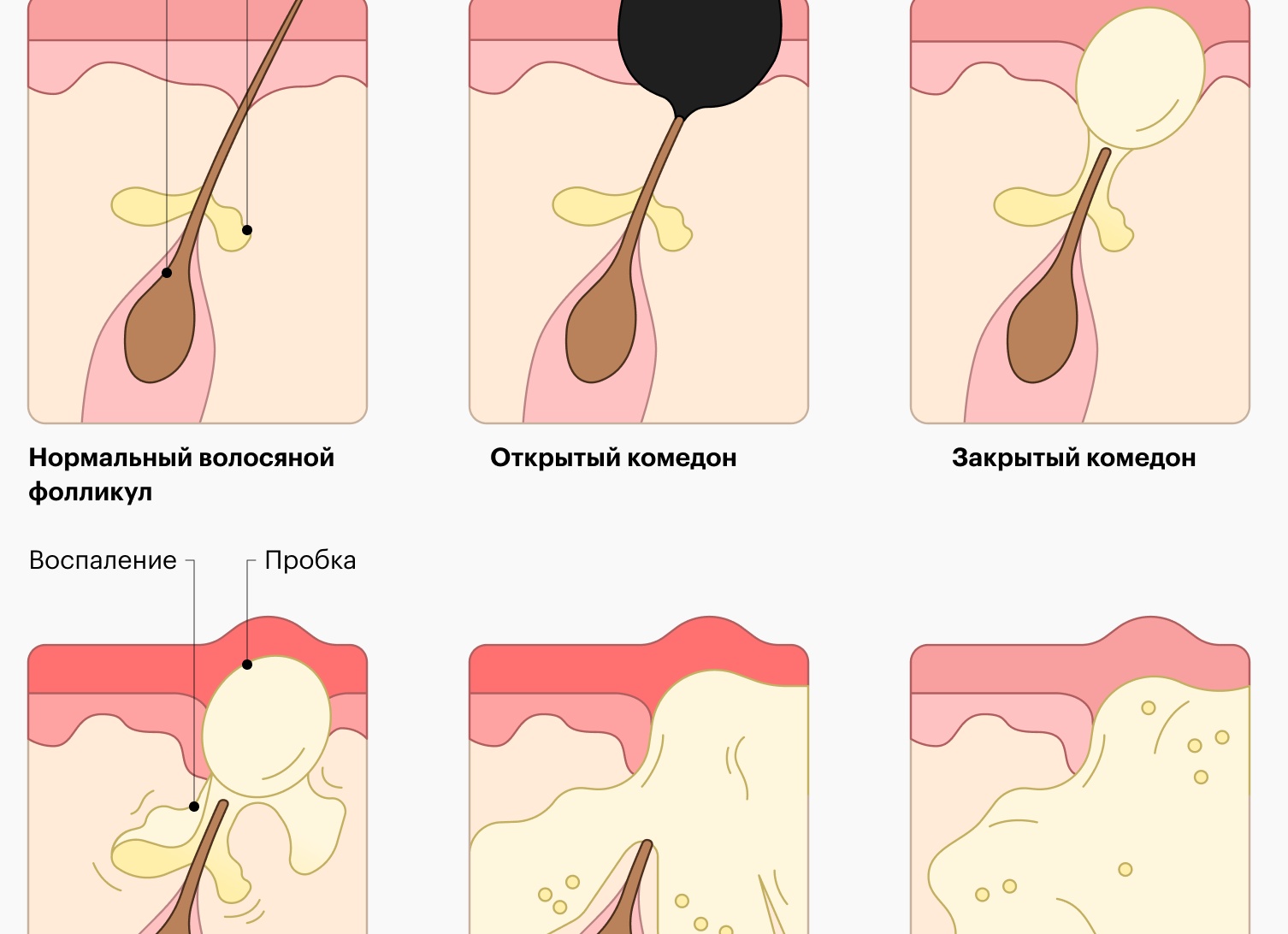 Помогает ли переливание крови от прыщей, сколько оно стоит и как его делают