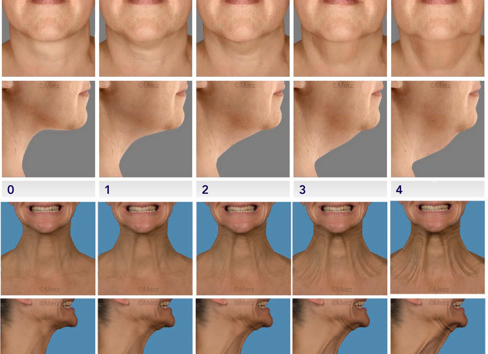 Как быстро избавиться от второго подбородка в домашних условиях