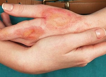 Чем лечить псориаз на руках на ранней стадии