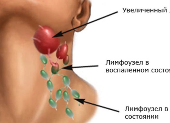 Увеличенные лимфоузлы на шее у ребенка: причины, симптомы, методы лечения Увеличенные лимфоузлы на шее у ребенка: причины, симптомы, методы лечения
