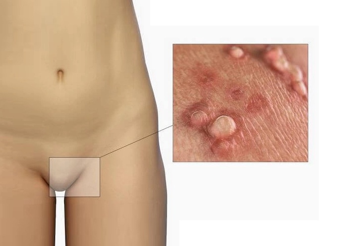 Как убрать папилломы на половых губах