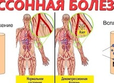 Что такое кессонная болезнь и как ее лечить? Что такое кессонная болезнь и как ее лечить?