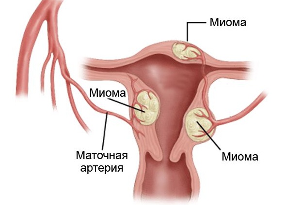 Характерные симптомы миомы матки и возможные способы ее лечения Характерные симптомы миомы матки и возможные способы ее лечения