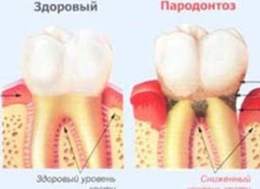 Как лечить пародонтоз в домашних условиях аптечными и народными средствами