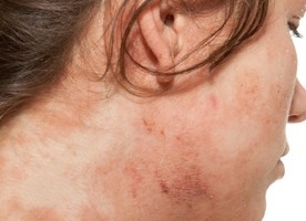 Детский лямблиоз: симптоматика, диагностика и лечение