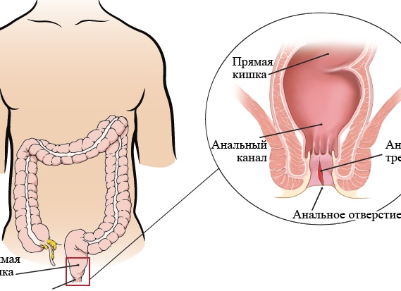 Причины возникновения и лечение трещин на пятках