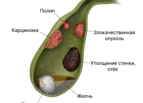 Почему образуются полипы в желчном пузыре, какое лечение назначают врачи
