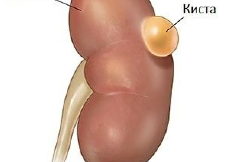 Как лечить кисту почки у женщин и мужчин