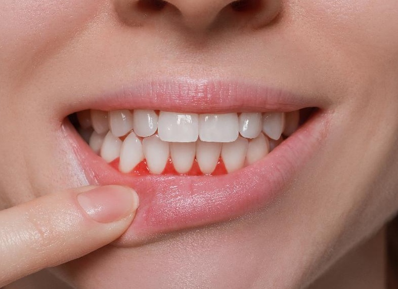 Кровоточат десна — что делать, как лечить их в домашних условиях