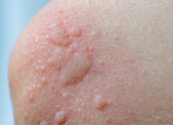 Лечение хронического панкреатита медикаментами и народными средствами