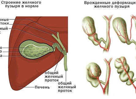 От чего возникает деформация желчного пузыря, как ее исправляют От чего возникает деформация желчного пузыря, как ее исправляют