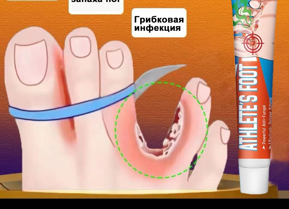 Лечение грибка между пальцами ног: список лекарств