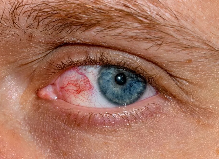 Покраснение глаз: фото, возможные причины и методы лечения