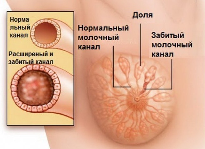 Симптомы и лечение лактостаза у кормящей матери