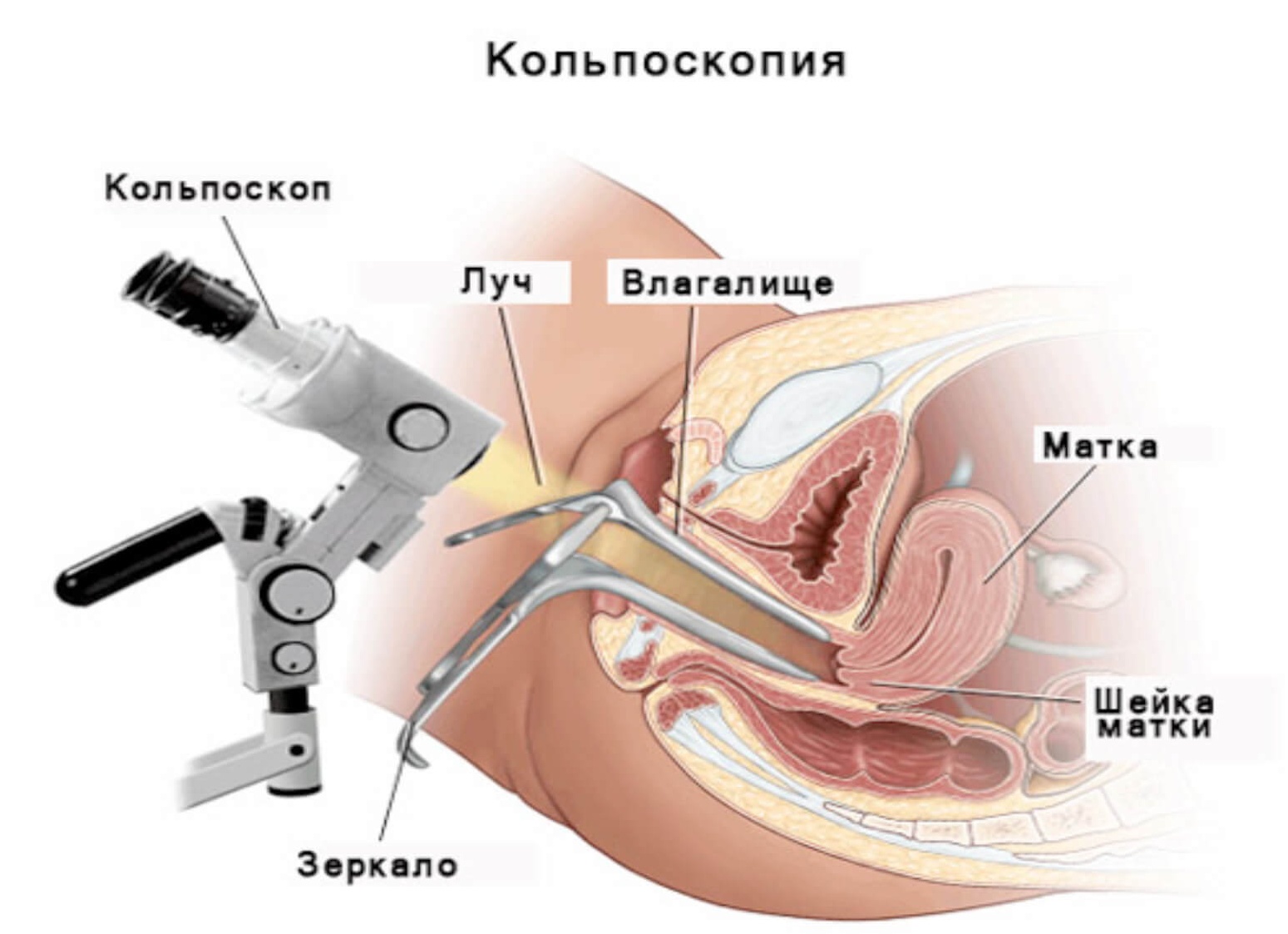 Кольпоскопия шейки матки: особенности проведения и результаты Кольпоскопия шейки матки: особенности проведения и результаты