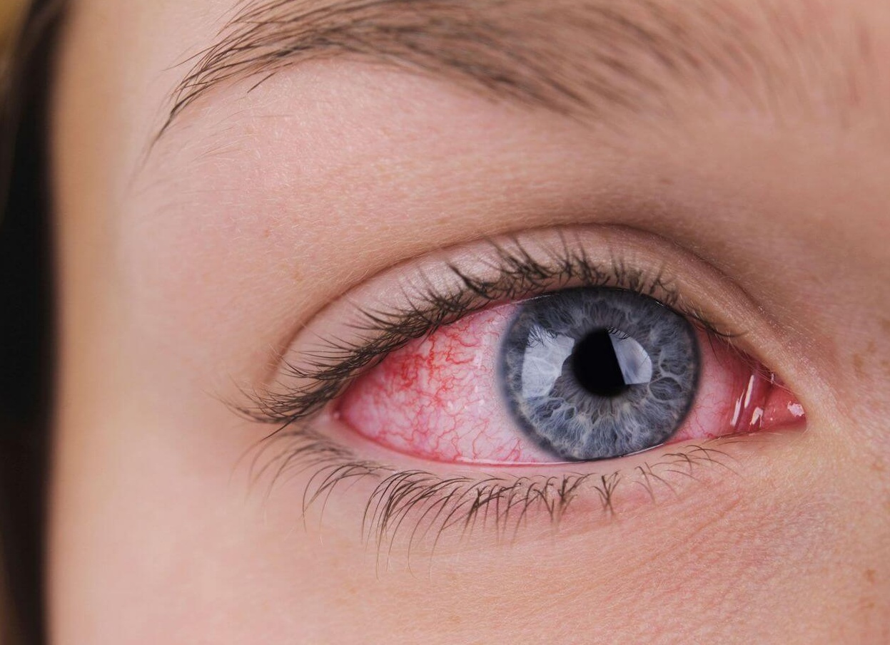 Почему краснеют глаза у ребенка или взрослого, что можно предпринять Почему краснеют глаза у ребенка или взрослого, что можно предпринять