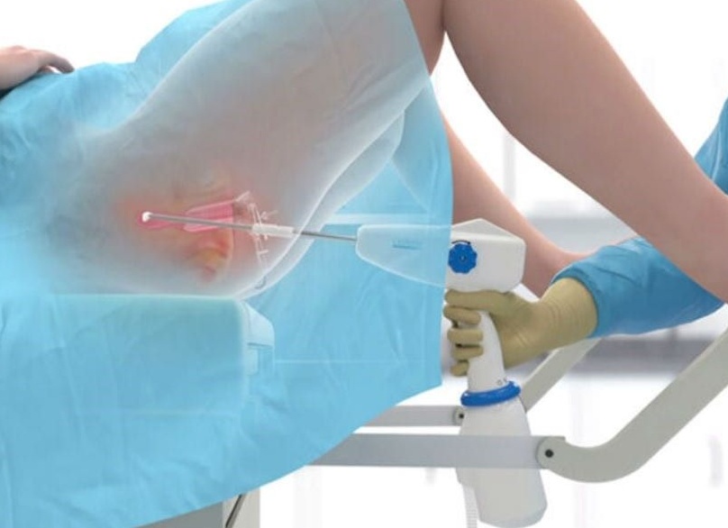 Как происходит удаление полипа в матке на гистероскопии