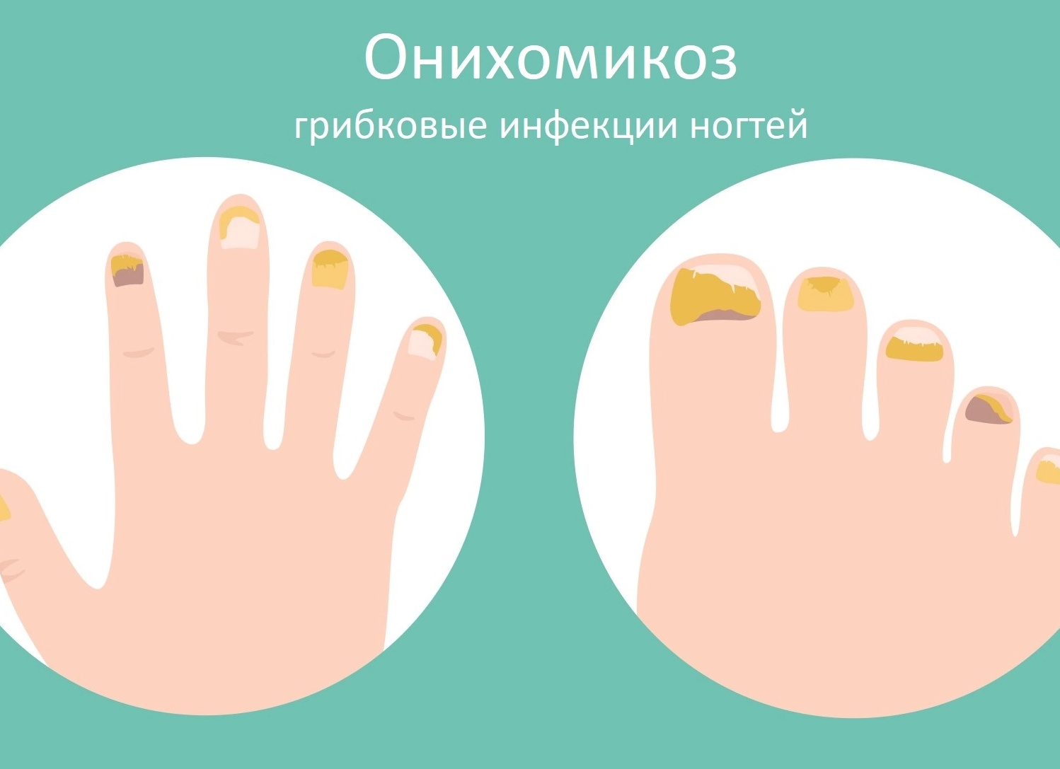 Методы лечения грибка ногтей рук в домашних условиях Методы лечения грибка ногтей рук в домашних условиях