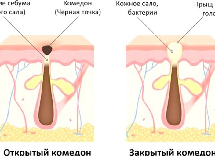 Как убрать белые точки на лице ребенка и взрослого Как убрать белые точки на лице ребенка и взрослого