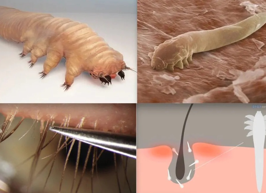 Как избавиться от подкожного клеща на лице