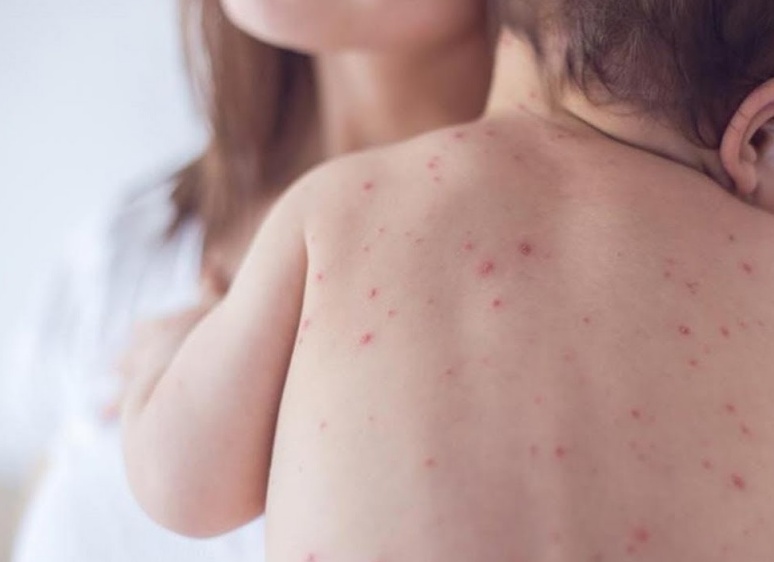 Как проявляется и лечится краснуха у детей Как проявляется и лечится краснуха у детей