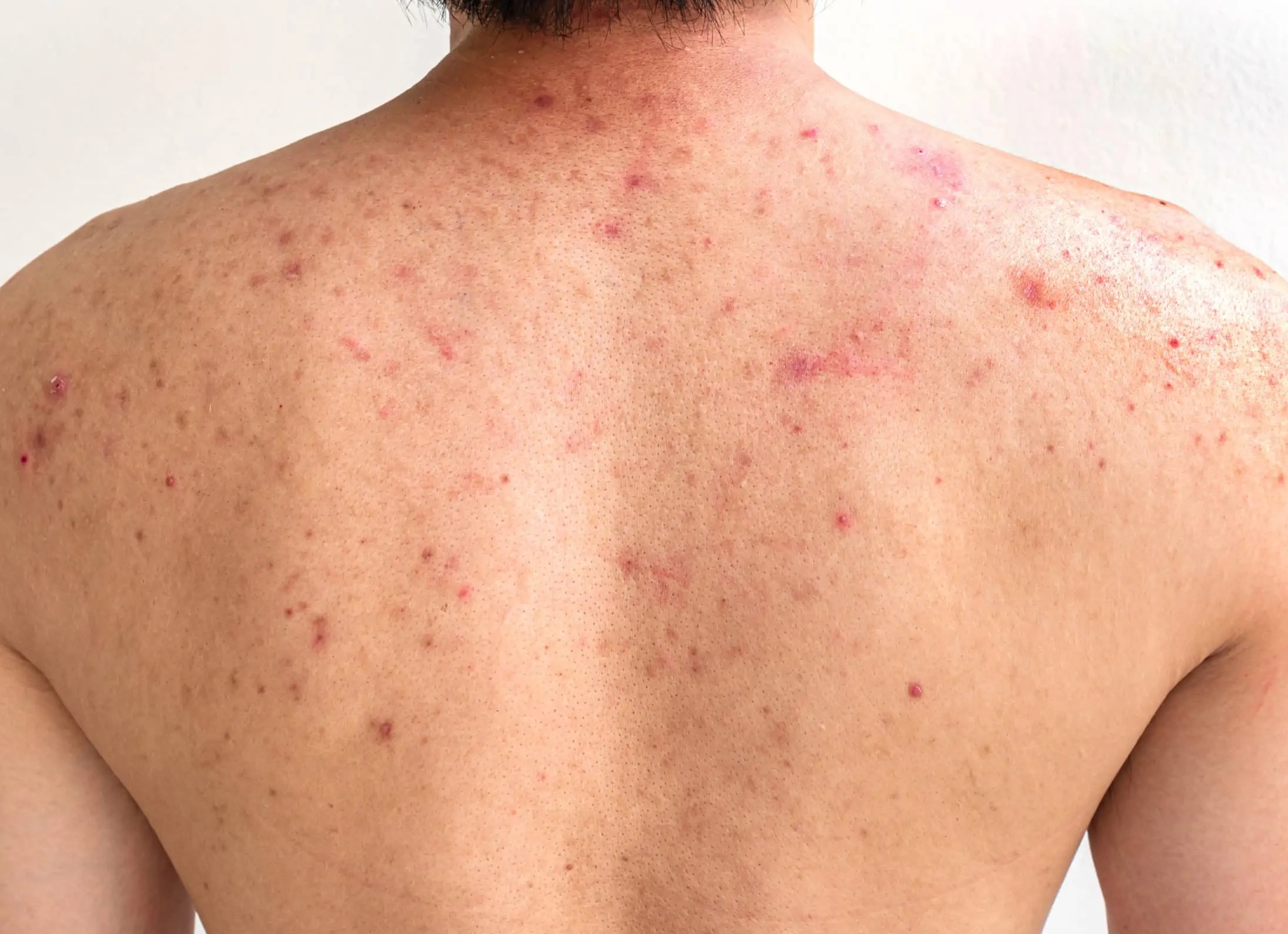 Как вылечить прыщи на спине у женщин Как вылечить прыщи на спине у женщин