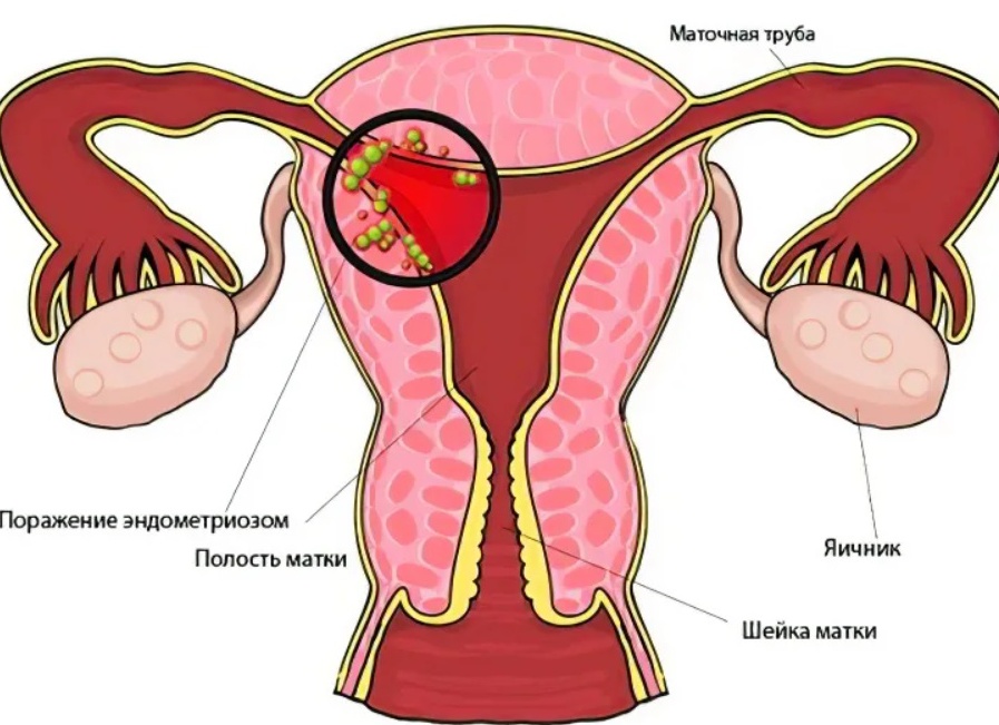 Что такое эндометриоз матки и как его лечить
