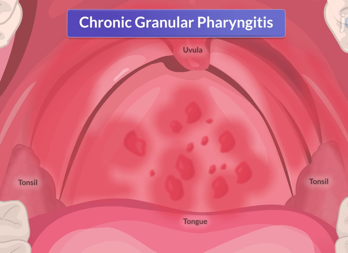 Методы лечения острого и хронического фарингита у взрослых Методы лечения острого и хронического фарингита у взрослых