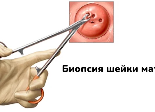 Как проводится биопсия шейки матки