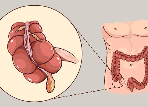 Как определить симптомы аппендицита у мужчин