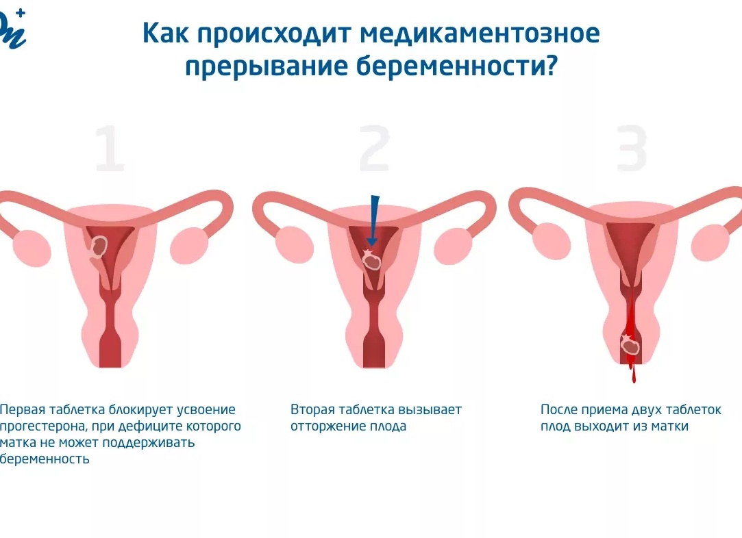 Как проходит медикаментозное прерывание беременности