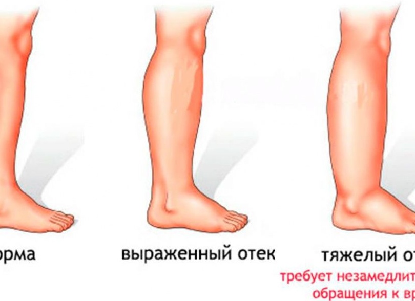 Почему появляются отеки на ногах у пожилых людей, как их правильно лечить