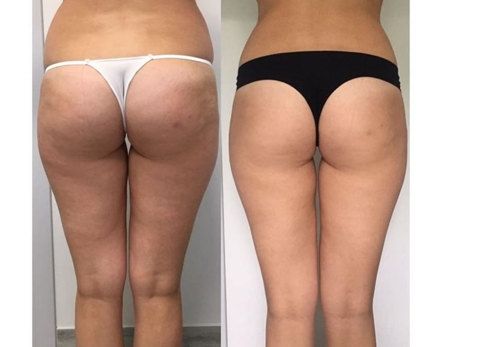 Как эффективно избавиться от целлюлита на ногах и попе