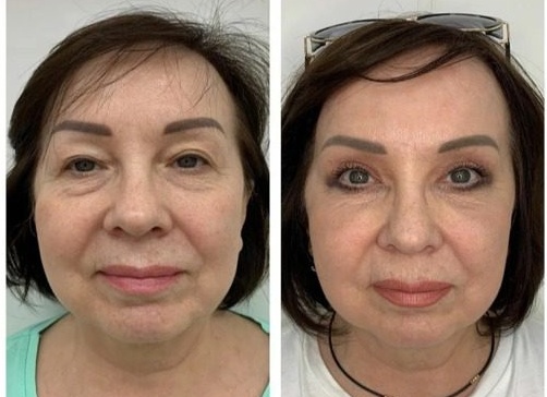 Нити для подтяжки лица: виды, эффективность, отзывы