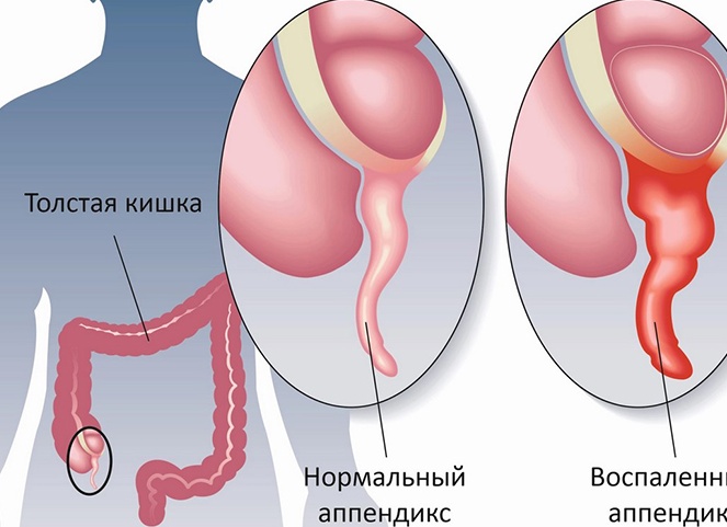 Первые признаки аппендицита у детей Первые признаки аппендицита у детей