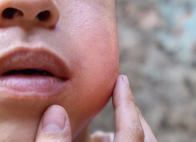 Свинка у детей и взрослых: симптомы и лечение Свинка у детей и взрослых: симптомы и лечение