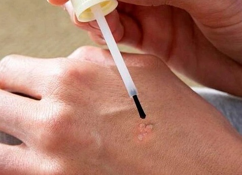 Методы удаления папиллом в домашних условиях