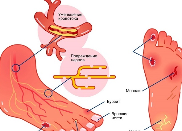 Что такое диабетическая стопа: описание, фото, симптомы и лечение Что такое диабетическая стопа: описание, фото, симптомы и лечение