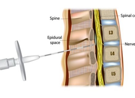 Что такое эпидуральная анестезия и когда ее проводят?