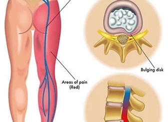 Симптомы ущемления седалищного нерва, правила лечения